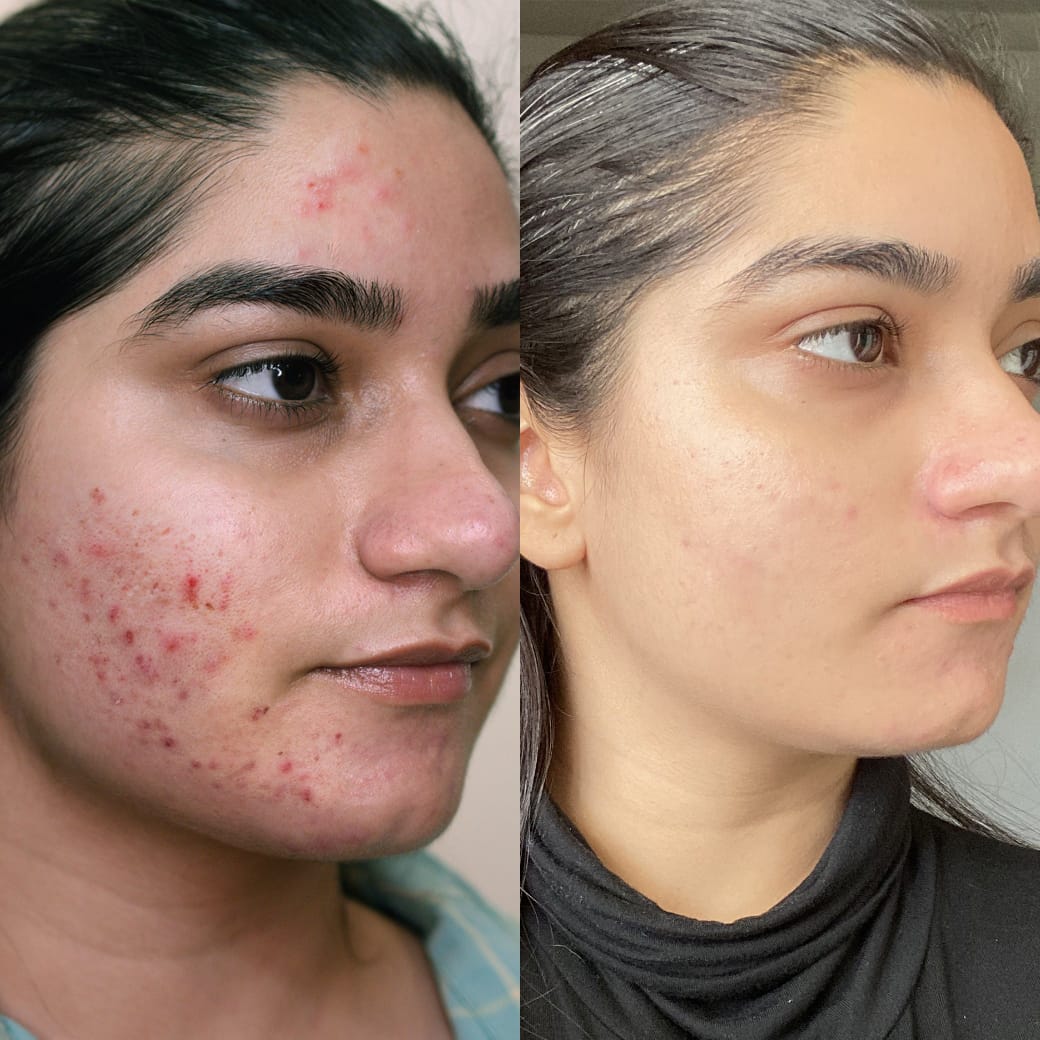 ANTI-ACNE BAR